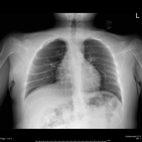 apical chest x ray.